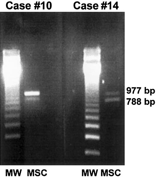Fig. 2. PCR-based amelogenin gene amplification. / Marrow stromal cells from 2 female patients who received allografts from male donors (case nos. 10 and 14) were generated in vitro, extensively depleted of monocyte-macrophages, and analyzed by PCR for the presence of donor-derived mesenchymal cells. In both cases, a 788 fragment located on the Y chromosome and a 977 fragment located on the X chromosome were detected, thus demonstrating the partial male origin of stromal cells.