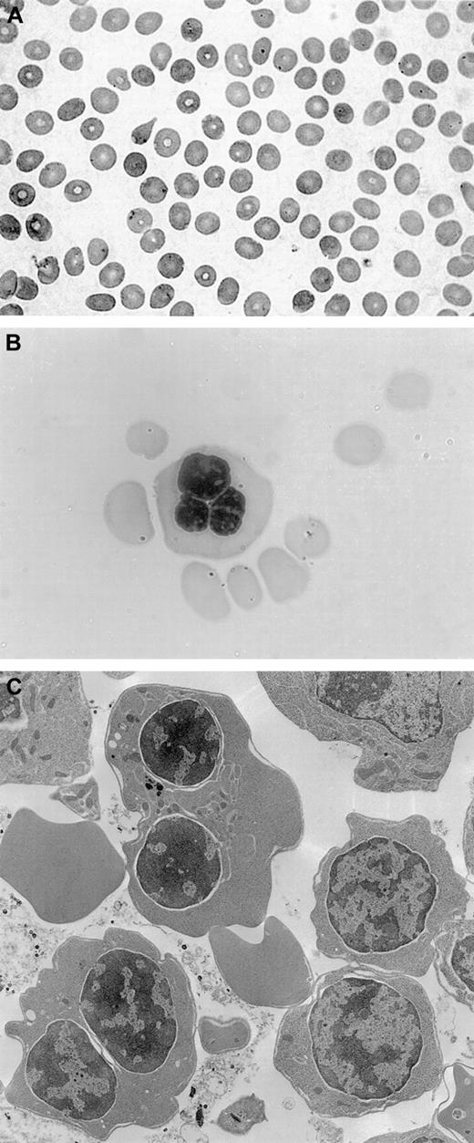 Fig. 1. Peripheral blood smear, bone marrow aspirate, and electron microscopy findings. / (A) Peripheral blood smear, showing macrocytosis. (B) Bone marrow aspirate with a multinucleated erythroblast. (C) Electron microscopy findings with evidence of double membranes on erythroid precursors.
