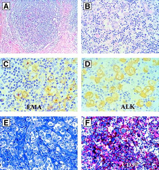 Fig. 3. Hodgkin-like ALCL. / (A-D) Hodgkin-like ALCL, ALK+. (A) Morphology at low magnification (hematoxylin and eosin). Note the nodular sclerosis. (B) Same case as in (A) at higher magnification. The large tumor cells resemble Hodgkin- and Reed-Sternberg cells. (C) Same case as in (A) immunostained for EMA (antibody clone E29). All tumor cells are labeled. (D) Same case as in (A) immunostained for ALK (antibody clone ALK1). The tumor cells show a strong positivity of their cytoplasm. (E,F) Hodgkin-like ALCL, ALK−. (E) Morphology by Giemsa stain. (F) Immunoreactivity for CD30 (antibody clone Ber-H2; alkaline phosphatase–antialkaline phosphatase). All tumor cells are strongly CD30-positive, but ALK-negative (not shown).