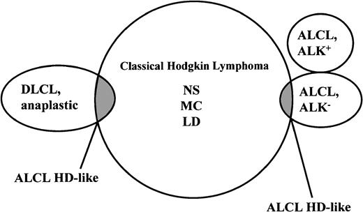 Fig. 4. Current morphologic and immunophenotypic overlaps of true ALCLs and anaplastic large B-cell lymphomas with classic Hodgkin disease. / The REAL classification refers to the overlapping neoplasms as ALCL–HD-like because they cannot, because of missing morphologic and immunophenotypic criteria, be allocated to one of the established lymphoma entities. The overlap between ALK+ ALCL and Hodgkin disease has disappeared with the availability of monoclonal antibodies to ALK protein, which strongly stain the tumor cells of all cases of ALCL with a rearranged ALK gene but consistently fail to stain Hodgkin and Reed-Sternberg cells of Hodgkin disease.