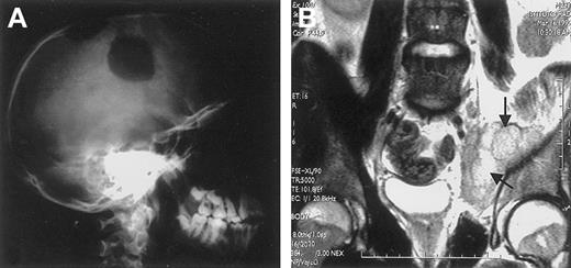Fig. 10. Extranodal involvement in ALK+ ALCL. / (A) Large osteolytic lesions of the skull in a 14-year-old boy. (B) Involvement of the right obturator muscle (arrows) in a 25-year-old man.