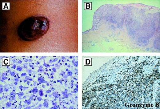 Fig. 12. Primary cutaneous anaplastic large cell lymphomas. / (A) Macroscopic appearance: ulcerated reddish-violet tumor of the skin. (B) Histologic appearance of the same lesion as in (A) at low magnification (hematoxylin and eosin). (C) Cytologic composition of the same lesion as in (A) and (B). Note the presence of many large anaplastic cells; they are strongly CD30+ (not shown) (hematoxylin and eosin). (D) Immunoreactivity of the same lesion as in (A), (B), and (C) for the cytotoxic molecule granzyme B. All of the tumor cells are strongly positive (antibody clone GrB-7, avidin-biotin-peroxidase).