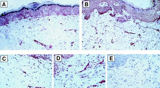 Fig. 6. Effect of human sCD40L on VEGF-expression in vivo. / Immunohistochemical staining of VEGF in vivo in representative human skin transplants on SCID mice following injection of Matrigel without (panels A and C) or with (panels B and D) human sCD40L. Representative areas of panels A and B (200 × magnification) are viewed at high-power magnification (800 ×) in panels C and D, respectively. Consistently, there was enhanced expression of VEGF in sCD40L-treated human skins in multiple cells. There was no staining of the specimens with medium alone or isotype control antibody. Panel E represents the negative control staining of the same sample as in Panel D (800 ×).