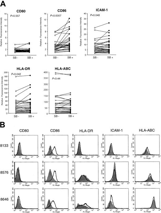 Fig. 8. Up-regulation of costimulatory molecules in clinical AML samples. / (A) Thirty clinically isolated AML cells were incubated with SB for 48 hours to detect the altered expression of CD80, CD86, HLA-DR, HLA-ABC, and ICAM-1 by flow cytometry. Relative fluorescence intensity of medium-treated (SB−) and SB-treated (SB+) cells are shown as open and closed circles, respectively. Statistical significance of each expression between medium-treated and SB-treated samples was analyzed by the Wilcoxon rank sum test, and P is shown. (B) Four of 30 samples exhibited more than a 3-fold increase in the expression (MFI) of CD86. The data of 3 of these 4 samples (UPN 8133, 8576, and 8646) are shown as the highest responders.