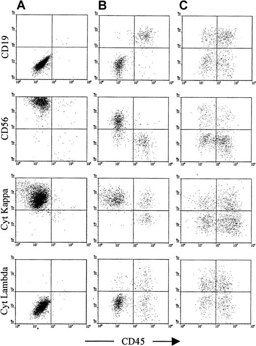Fig. 3. Confirmation of light-chain restriction in samples with an excess of phenotypically neoplastic plasma cells. / This figure shows representative plots from 3 patients. (A) A patient with myeloma at presentation, with only neoplastic phenotype (CD19−CD56+) plasma cells detectable. (B) A MGUS patient with more than 80% of CD45− plasma cells having a neoplastic phenotype (CD19−CD56+). (C) A MGUS patient with a small population of phenotypically neoplastic plasma cells (in this case, approximately 20% of total plasma cells). For both patients (A) and (B), there is clear cytoplasmic light-chain restriction in the CD45− plasma cell population. For patient B, the CD45+ plasma cell population is polyclonal. For patient (C), the neoplastic clone is at a low level, and both CD45+ and CD45− are polyclonal, although there is a slight lambda preponderance within the CD45−population. MGUS patients were considered suitable for comparison of neoplastic and normal plasma cell CD126 expression if their phenotypic profile was similar to that of patient (B), whereas MGUS patients with a phenotypic profile similar to that of patient (C) were excluded from further analysis.