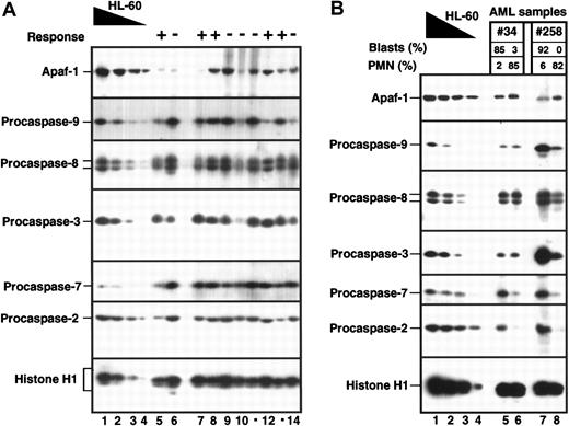 Fig. 2. Variations in Apaf-1 and procaspases in various pretreatment bone marrow samples. / (A) Aliquots containing 5 × 105 marrow mononuclear cells (at least 80% blasts) from patients with newly diagnosed AML (lanes 5-14) were subjected to SDS-PAGE, followed by blotting with reagents that recognize the indicated polypeptide. To provide a standard curve, aliquots containing 5 × 105, 2.5 × 105, 1.25 × 105, and 0.5 × 105 untreated HL-60 cells (lanes 1-4, respectively) were loaded onto each blot. The response of each patient to the first cycle of induction therapy is denoted above each lane as follows: − indicates NR; + indicates CR; 0 indicates UE. (B) Aliquots containing 5 × 105 mononuclear cells (lanes 5 and 7) or granulocytes (lanes 6 and 8) from the same AML marrows were analyzed as in panel A. Differential counts in each sample are indicated above each lane.