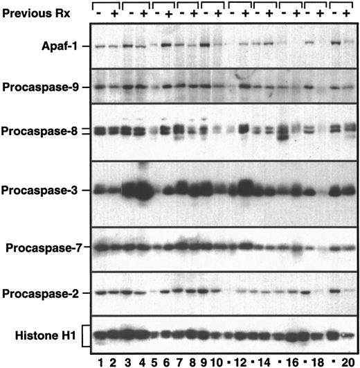 Fig. 7. Comparison of Apaf-1 and procaspases in paired leukemia samples. / Aliquots containing 5 × 105 marrow mononuclear cells harvested before initial chemotherapy (−, odd lanes) and again from the same patient at the time of leukemia regrowth (+, even lanes) were subjected to SDS-PAGE, followed by blotting with reagents that recognize the indicated polypeptide. To provide a standard curve, aliquots containing 5 × 105, 2.5 × 105, 1.25 × 105, and 0.5 × 105 untreated HL-60 cells were loaded onto each blot as shown in Figures 1 through 3. Blots were scanned and quantitated as described in “Materials and methods.”