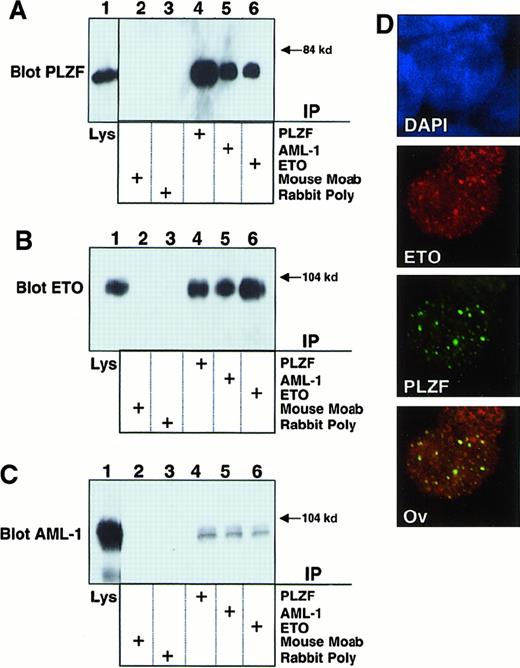 Fig. 1. AML-1/ETO interacts with PLZF. / 293T cells were transfected with 750 ng each of pCMV-AML-1/ETO and pCDNA-PLZF expression vectors. The cells were lysed and subjected to immunoprecipitations and immunoblotting as indicated. (A) Immunoblot with PLZF mouse monoclonal antibody. (B) Immunoblot with ETO C-terminal rabbit polyclonal antibody. (C) Immunoblot with AML-1 runt domain rabbit polyclonal antibody. The lanes of all 3 panels correspond to similar experiments. Lane 1, direct immunoblot of cell lysate. Lanes 2-6, extracts immunoprecipitated with mouse control antibody, rabbit control antibody, PLZF antibody, AML-1 antibody, and ETO antibody, respectively. (D) Immunofluorescence staining of 293T cells co-transfected with 100 ng PLZF and AML-1/ETO expression vectors. DAPI, nuclear staining. ETO, AML-1/ETO located using ETO polyclonal antibodies and Texas red–conjugated secondary antibodies. PLZF was detected using monoclonal antibodies and FITC-conjugated secondary antibodies. Ov, overlay of images of PLZF and AML-1/ETO. Magnification, 400×.