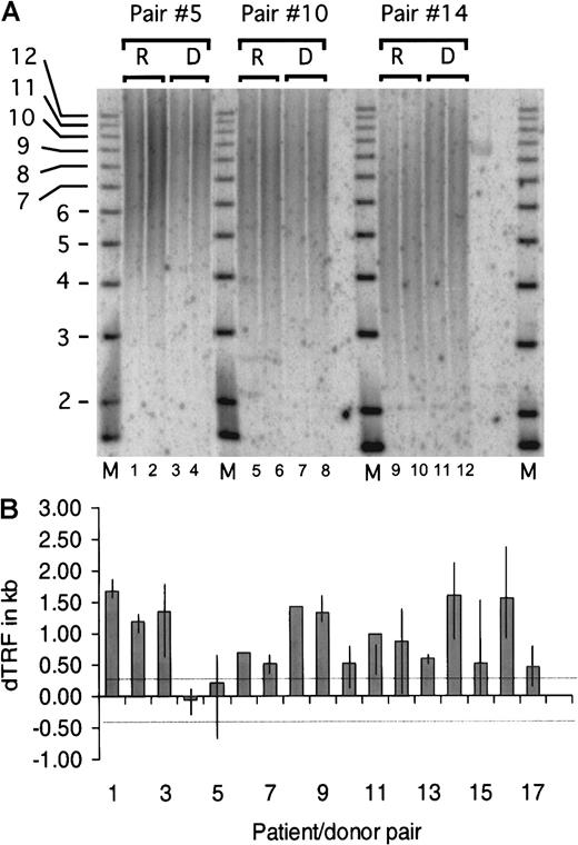 Fig. 1. Terminal restriction fragment length analysis on granulocyte DNA. / The donor's TRF minus the patient's TRF gives rise to the dTRF. TRF was calculated and compared between the duplicate samples. The average difference between each duplicate was calculated to be 104 base pairs (bp), and the SD was 88 bp. The lower limit of detection of the method was therefore selected as the average (104 bp) + 3 SD or 369 bp. Differences in TRF of fewer than 369 bp were considered not significant and ascribed to inherent experimental variability. One to 5 (median = 3) replicate experiments were performed with DNA from each of the 17 patient/donor pairs for a total of 50 TRF pairs (in 2 cases, only 1 experiment was done owing to limited DNA quantities). (A) Representative TRF analysis of patient/donor pairs 5, 10, and 14. High MW DNA was digested with HinfI and RsaI restriction enzymes and size-fractionated on a 0.8% agarose gel. Recipient and donor samples were loaded in duplicate lanes 1-4 (pair 5), 5-8 (pair 10), and 9-12 (pair 14), and a radiolabeled 1-kb DNA ladder MW marker was included (lanes M). In situ hybridization was performed with a P32 end-radiolabeled oligonucleotide probe comprising the telomere-specific sequence (TTAGGG)3. The signal was detected by scanning the gel by means of the Phosphorimager analysis system (Molecular Dynamics, Sunnyvale, CA). Mean TRF length was assigned to the MW corresponding to the distance of peak signal intensity from the origin of the electrophoresis. The MW was then calculated by means of the Imagequant (Molecular Dynamics) and Fragment (Molecular Dynamics) software. (B) dTRF data summary of each patient/donor pair. Each column represents the average dTRF of 1 to 5 (median 3) replicate experiments for each pair. The top and bottom ends of the vertical lines depict the maximum and minimum dTRF values obtained in each patient/donor pair. Single experiments were performed on pairs 6 and 8 because of limited amounts of DNA. The 2 thin dotted horizontal lines depict the experimental limit of detection, which was 369 bp as described in “Materials and methods.” When the average difference was computed across experiments for each individual patient, 15 of 17 recipients had dTRF more than 0.369 kb. Of the 15 recipients, 8 had dTRF of more than 1.0 kb and 7 had dTRF 0.3 to 1.0 kb. One of the remaining 2 recipients had dTRF of −0.1 kb, and the other, dTRF of 0.2 kb, both less than 0.369 kb.
