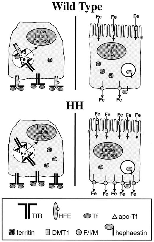 Fig. 3. Hereditary hemochromatosis exemplifies inappropriate regulation of the iron absorptive setpoint in the crypt. / Individuals with hereditary hemochromatosis (HH) have decreased levels of functional HFE. This contributes to a higher labile iron pool in the precursor cells of an individual with hereditary hemochromatosis than an individual with functional HFE (wild type). When the precursor cell of a hereditary hemochromatotic individual differentiates, the labile iron pool will initially be high. We speculate that this increase in the labile iron pool up-regulates machinery responsible for basolateral iron transfer such as Ferroportin1/Ireg1/MTP1 (F/I/M). The increased amount of basolateral iron efflux will lead to a depletion of the labile iron pool, which will increase levels of the apical iron transporter, DMT1. If Ferroportin1/Ireg1/MTP1 is a very stable protein, or its activity exceeds that of DMT1 in the individual with hereditary hemochromatosis, the iron efflux activity of that enterocyte will overcome the uptake activity of DMT1, keeping intracellular iron levels low. This model explains why individuals with hereditary hemochromatosis have higher levels of DMT1 and low ferritin levels in their duodenum and can be tested further by determining the activity of Ferroportin1/Ireg1/MTP1 in hereditary hemochromatotic individuals and controls as well as in HFE-deficient mice.