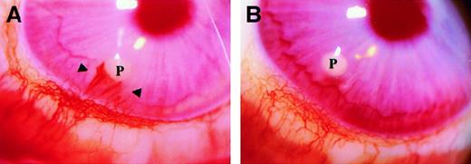 Fig. 5. Angiogenic activity of I-309 in the rabbit cornea. / Representative pictures of angiogenesis induced by 400 ng I-309 (A) and vehicle containing pellet (B). Photographs were taken at 15 days after implant through a slit-lamp stereomicroscope (Nikon, Tokyo, Japan). Magnification × 18. P indicates pellets.