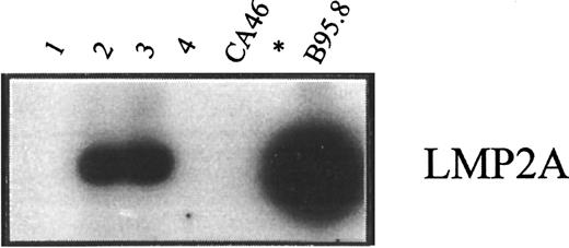 Fig. 7. RT-PCR analysis of LMP2A transcripts. / RT-PCR analysis was done of LMP2A transcripts in RNA preparations from enriched CD19+ cells of healthy carriers H2 and H1 (lanes 1 and 2) and from PBMCs of patients P1 and P2, both of whom had active PTLD (lanes 3 and 4). In each case, 5 μg RNA was used as the template for amplification. Positive and negative controls were RNA preparations from B95.8 and CA46 cells, respectively.