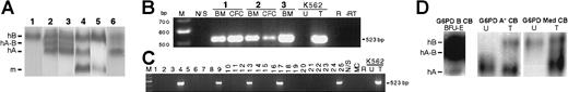 Fig. 4. Transfer and expression of hG6PD in human hematopoietic cells. / (A) Expression in short-term and long-term cultures in vitro. Human BM cells were transduced with retrovirus harboring the cDNA of hG6PD A, and then processed for methylcellulose colony assays and long-term cultures. 1, Untransduced human BM cells. Transduced human BM cells: 2, cells after 7 days in liquid culture; 3, pooled white and erythroid colonies; 4, adherent cells obtained at week 6 of a long-term BM culture (the m band derives from mouse MS-5 stromal cells). Controls: 5, mixture of human RBC G6PD B and of murine MS-5 cells; 6, RBCs from a woman heterozygous for G6PD B and G6PD A. hB, human G6PD B. hA, human G6PD A; hA-B, heterodimer of human G6PD A and B; m, murine G6PD. (B) Transfer and expression of hG6PD in human HSCs in vivo. RT-PCR analysis for the presence of hG6PD mRNA transcribed from integrated provirus in BM and human BM colonies (CFC) from 3 NOD-SCID mice transplanted with human HSCs.123 Positive control: transduced (T) human K562 cells. Negative controls: untransduced (U) K562 cells; untreated NOD/SCID mouse BM cells (N/S); R: reagent control; −RT: omission of reverse transcriptase. M, molecular weight marker. (C) PCR analysis of individual hematopoietic colonies from mouse 1 (Figure 4B): integrated provirus was present in 5 of 25 colonies. MC indicates methylcellulose control. (D) Expression of functional G6PD in vivo and correction of human G6PD deficiency. (Left) Electrophoretic analysis of human erythroid colonies (BFU-E) obtained from NOD/SCID mice 8 weeks after engraftment of G6PD B human cord blood transduced with an hG6PD A vector. (Right) Electrophoretic analysis of human HSCs from G6PD-deficient cord blood samples (G6PD A−and G6PD Mediterranean, respectively) after transduction with an hG6PD vector (G6PD B and G6PD A, respectively). In the case of G6PD Mediterranean, which entails a more severe quantitative defect than G6PD A−, the activity from the transferred gene is clearly higher than from the endogenous gene.