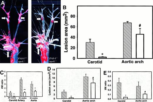 Fig. 1. Analysis of atherosclerosis. / (A) Oil red O staining of atherosclerotic lesions in aortic arch and carotid arteries of 52-week-old mice on normal chow. Atherosclerosis of the distal common carotid and carotid bifurcation is markedly diminished in the PAI-1−/−/apoE−/− mice compared to PAI-1+/+/apoE−/− mice, whereas atherosclerosis involving the aortic arch appears similar. Arrows show aortic arch (vertical) and carotid bifurcation (horizontal). (B) Quantitation of aortic and carotid arterial atherosclerosis in 52-week-old PAI-1−/−/apoE−/− mice (n = 8) (■) and PAI-1+/+/apoE−/− mice (n = 6) (▧) on normal chow. *P < .0003, #P > .1. (C) Cross-sectional area of atherosclerotic lesions in 30-week-old PAI-1−/−/apoE−/− (n = 10) and PAI-1+/+/apoE−/− mice (n = 7) maintained on normal chow and in 52-week-old PAI-1−/−/apoE−/− (n = 9) and PAI-1+/+/apoE−/− mice (n = 6) maintained on normal chow. Intima-to-media (I/M) ratio in PAI-1−/−/apoE−/− mice (■) and PAI-1+/+/apoE−/− mice (▧). *P < .01, **P < 2 × 10−8. (D) Quantification of lesion area in 18-week-old PAI-1−/−/apoE−/− mice (n = 5) (■) and PAI-1+/+/apoE−/− mice (n = 5) (▧) on high-fat chow. *P < .05, #P > .2. (E) I/M ratios in PAI-1−/−/apoE−/− mice (n = 5) (■) and PAI-1+/+/apoE−/− mice (n = 5) (▧) on high-fat chow. *P < .05, #P > .1.