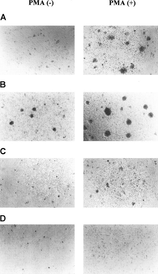Fig. 5. MFT3-negative T-cell clones showed increased homocytic aggregation compared with MFT3-positive T-cell clones. / MFT3-negative T-cell clones KGU140 (A) and KSB2 (B) and MFT3-positive T-cell clones KGU139 (C) and KGX114 (D) were cultured in the presence or absence of 10 ng/mL phorbol 12-myristate 13-acetate for 16 hours and observed using inverted microscopy (magnification, ×100).