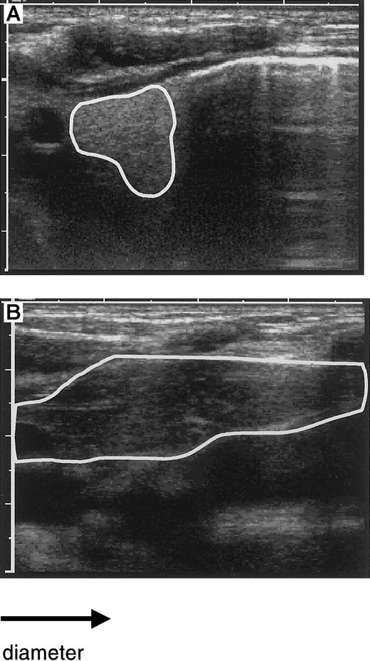 Fig. 2. Evaluation of thymic size by ultrasound. / The size of the left retrosternal thymic lobe as visualized by ultrasound is circumscripted: before transplantation with a diameter of 1 cm (A) and after transplantation with a diameter of more than 4 cm (B). Note the enhanced density before transplantation with normalization after transplantation.