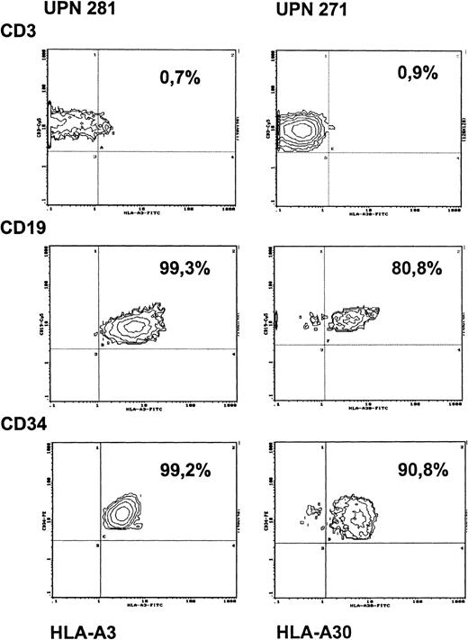 Fig. 4. Chimerism of PBMCs and of bone marrow CD34+cells after HLA-nonidentical transplantation in a patient without conditioning (UPN 281) and in a patient with preconditioning (UPN 271). / Antibodies against HLA-A3 (UPN 281) and against HLA-A30 (UPN 271) were used as recipient-specific markers. PBMCs from respective donors were used as negative controls (staining < 1% with the recipient-specific HLA-antibodies) and from opposite parents as positive controls (staining > 99% with recipient-specific HLA antibodies).