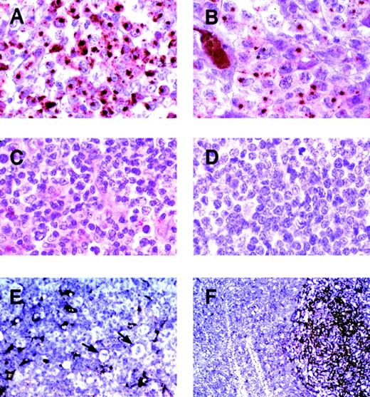 Fig. 3. Expression of clusterin in representative primary lymphoid neoplasms. / Immunohistochemistry was performed using the anticlusterin antibody. (A) and (B) Two anaplastic large cell lymphomas, positive for clusterin. Note the strong characteristic Golgi staining (original magnification × 400). (C) Peripheral T-cell lymphoma, negative for clusterin (original magnification × 400). (D) Nasal NK/T cell lymphoma, negative for clusterin (original magnification × 400). (E) Nodular sclerosis Hodgkin disease (original magnification × 200). Reed-Sternberg cells and variants are negative for clusterin (arrows). Residual dendritic cells or fibroblastic reticulum cells are positive. (F) Reactive lymphoid hyperplasia (original magnification × 100). A reactive follicle shows intense staining of dendritic cells with weaker staining of interfollicular reticular cells. Normal B and T lymphocytes show no staining.