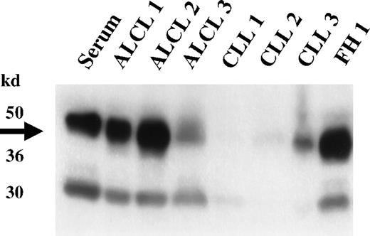 Fig. 4. Expression of clusterin in primary lymphoid neoplasms. / Western analysis of representative lymphoid neoplasms was performed using a clusterin antibody specific to the α subunit. High-level expression of clusterin is detected in the 3 primary ALCL cases (ALCL 1-3); none or lesser amounts are seen in 3 representative cases of CLL (CLL 1-3). The limited expression of clusterin seen in the non-ALCL cases is presumably derived from trapped serum or from residual dendritic cells present in the biopsy specimens. High-level expression of clusterin is also seen in a reactive lymph node (FH1), showing marked follicular hyperplasia with accompanying follicular dendritic cell proliferation.