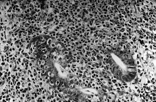 Fig. 1. MALT lymphoma of the stomach: histologic features. / The neoplastic lymphocytes infiltrate some residual gastric glands, giving rise to lymphoepithelial lesions (Giemsa staining, × 512, courtesy of Prof Stefano Pileri, University of Bologna, Italy).