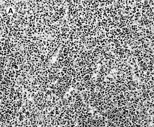 Fig. 1. Histologic findings in spleen. / (A) Section of spleen from case 2 shows depletion of white pulp and prominent sinusoidal small lymphoid infiltrates (hematoxylin and eosin, × 200). (B) The lymphocytes lack significant cytologic atypia. There is marked hemophagocytosis (hematoxylin and eosin, × 600).