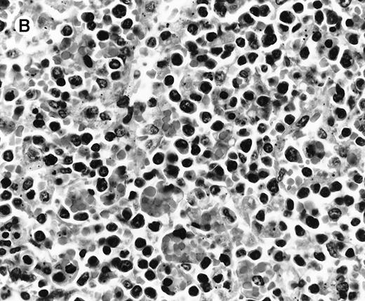 Fig. 1. Histologic findings in spleen. / (A) Section of spleen from case 2 shows depletion of white pulp and prominent sinusoidal small lymphoid infiltrates (hematoxylin and eosin, × 200). (B) The lymphocytes lack significant cytologic atypia. There is marked hemophagocytosis (hematoxylin and eosin, × 600).