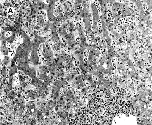Fig. 2. Histologic findings in the liver. / (A) Liver specimen from case 1 shows prominent portal and sinusoidal lymphoid infiltrate (hematoxylin and eosin, × 200). (B) The infiltrating lymphocytes are small and lack cytologic atypia (hematoxylin and eosin, × 600).