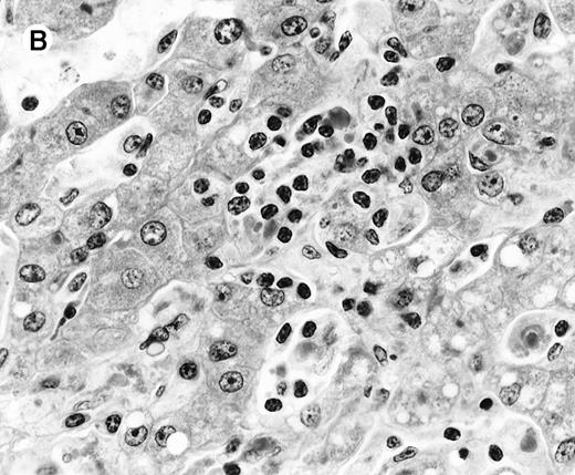 Fig. 2. Histologic findings in the liver. / (A) Liver specimen from case 1 shows prominent portal and sinusoidal lymphoid infiltrate (hematoxylin and eosin, × 200). (B) The infiltrating lymphocytes are small and lack cytologic atypia (hematoxylin and eosin, × 600).