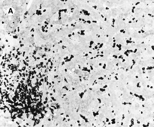 Fig. 3. Liver infiltrate from case 1. / The infiltrating lymphocytes are predominantly CD3+ T cells (panel A), with only rare L26+ B cells (panel B) (immunoperoxidase stained, hematoxylin counterstained, × 200).