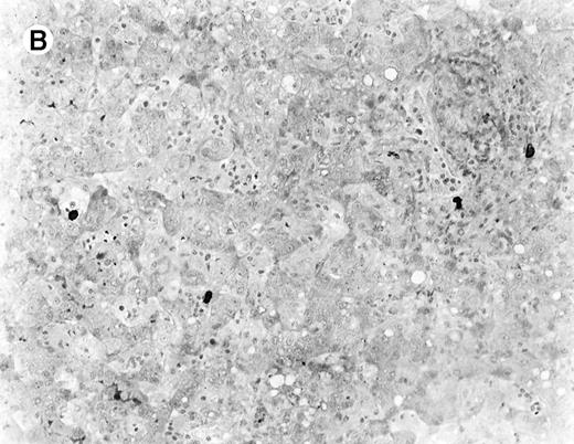 Fig. 3. Liver infiltrate from case 1. / The infiltrating lymphocytes are predominantly CD3+ T cells (panel A), with only rare L26+ B cells (panel B) (immunoperoxidase stained, hematoxylin counterstained, × 200).