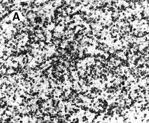 Fig. 4. Staining for CD4 and CD8 in spleen from case 2. / (A) The lymphoid infiltrate in the spleen is predominantly CD8+. (B) Staining for CD4 highlights erythrophagocytic histiocytes, whereas the lymphocytes are negative. (C) The small lymphocytes express TIA-1. (D) They are BF1+ and are strongly EBER-1+ (E) (immunoperoxidase stained, hematoxylin counterstained, × 200).