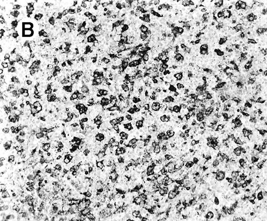 Fig. 4. Staining for CD4 and CD8 in spleen from case 2. / (A) The lymphoid infiltrate in the spleen is predominantly CD8+. (B) Staining for CD4 highlights erythrophagocytic histiocytes, whereas the lymphocytes are negative. (C) The small lymphocytes express TIA-1. (D) They are BF1+ and are strongly EBER-1+ (E) (immunoperoxidase stained, hematoxylin counterstained, × 200).