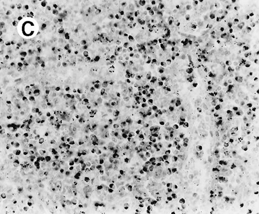 Fig. 4. Staining for CD4 and CD8 in spleen from case 2. / (A) The lymphoid infiltrate in the spleen is predominantly CD8+. (B) Staining for CD4 highlights erythrophagocytic histiocytes, whereas the lymphocytes are negative. (C) The small lymphocytes express TIA-1. (D) They are BF1+ and are strongly EBER-1+ (E) (immunoperoxidase stained, hematoxylin counterstained, × 200).