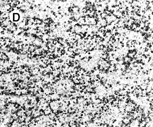 Fig. 4. Staining for CD4 and CD8 in spleen from case 2. / (A) The lymphoid infiltrate in the spleen is predominantly CD8+. (B) Staining for CD4 highlights erythrophagocytic histiocytes, whereas the lymphocytes are negative. (C) The small lymphocytes express TIA-1. (D) They are BF1+ and are strongly EBER-1+ (E) (immunoperoxidase stained, hematoxylin counterstained, × 200).