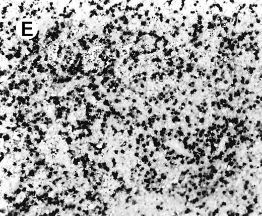 Fig. 4. Staining for CD4 and CD8 in spleen from case 2. / (A) The lymphoid infiltrate in the spleen is predominantly CD8+. (B) Staining for CD4 highlights erythrophagocytic histiocytes, whereas the lymphocytes are negative. (C) The small lymphocytes express TIA-1. (D) They are BF1+ and are strongly EBER-1+ (E) (immunoperoxidase stained, hematoxylin counterstained, × 200).