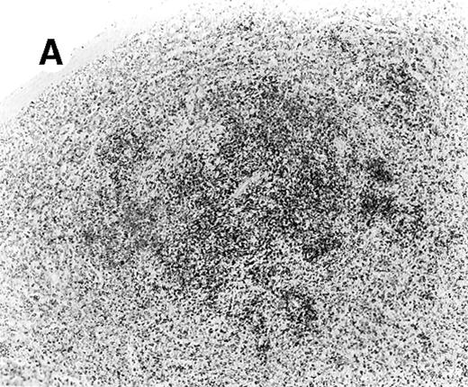 Fig. 5. Staining for CD4 and CD8 in spleen from case 4. / (A) Low-power view of spleen shows that the lymphoid nodules are composed predominantly of CD4+ cells. (B) Relatively few CD8+ cells are seen. (C) The CD4+ cells are also EBER1+ (immunoperoxidase stained, hematoxylin counterstained, × 50).