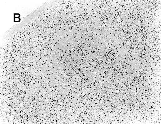 Fig. 5. Staining for CD4 and CD8 in spleen from case 4. / (A) Low-power view of spleen shows that the lymphoid nodules are composed predominantly of CD4+ cells. (B) Relatively few CD8+ cells are seen. (C) The CD4+ cells are also EBER1+ (immunoperoxidase stained, hematoxylin counterstained, × 50).