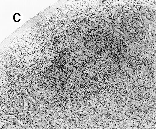 Fig. 5. Staining for CD4 and CD8 in spleen from case 4. / (A) Low-power view of spleen shows that the lymphoid nodules are composed predominantly of CD4+ cells. (B) Relatively few CD8+ cells are seen. (C) The CD4+ cells are also EBER1+ (immunoperoxidase stained, hematoxylin counterstained, × 50).