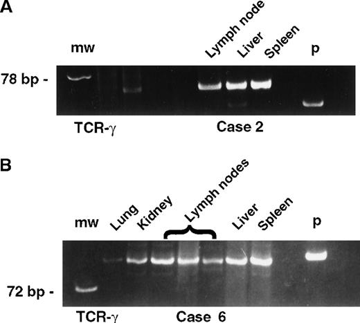 Fig. 7. PCR for TCR-γ gene. / PCR demonstrates an identical T-cell clone in the lymph node, liver, and spleen in case 2 (A) and in the lung, kidney, lymph nodes, liver, and spleen in case 6 (B) (ethidium-bromide-stained gel; p indicates positive control; mw, molecular weight size marker).