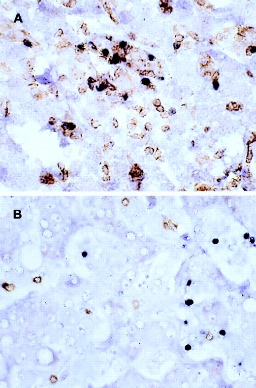 Fig. 6. Double staining for CD4/EBER and CD8/EBER. / Double staining of the liver from case 1 shows that (A) the CD4+ population harbors the EBV, whereas (B) CD8+ population is clearly negative (EBER1 RNA ISH, immunoperoxidase stained with DAB chromogen, hematoxylin counterstained, × 600).