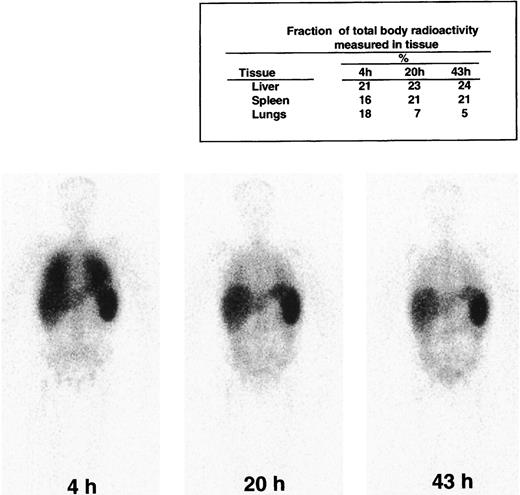 Fig. 2. Whole-body γ-camera images from 1 representative patient who received 2.5 × 109 indium 111–oxine–labeled CD4/CD3-ζ–modified CD8+ T cells in a total of 1010 gene-modified cells at time 0. / The images shown are anterior projection geometric means from 4, 20, and 43 hours after infusion of cells.