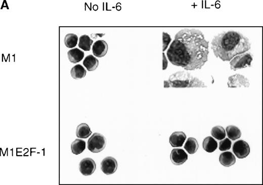 Fig. 3. Analysis of the morphologic characteristics of M1 and M1E2F-1 cells before and after treatment with IL-6. / (A) Representative photomicrographs of May-Grünwald-Giemsa–stained cytospin smears of cells are shown (magnification, ×400). Cells were seeded at 0.1 × 106/mL and treated with IL-6 (50 ng/mL) for 3 days before they were collected for analysis. (B) Cell-type distribution of M1 and M1E2F-1 cells at 3 days after IL-6 stimulation. Morphologic differentiation was determined by counting at least 300 cells on stained cytospin smears, and scoring the proportion of immature blast cells, cells at intermediate stages of differentiation, and mature macrophages. For each cell type, analysis was performed several times with similar results. The data represent a mean value obtained from at least 3 independent determinations and have a standard deviation of ± 15%. Furthermore, there was no difference in the response of the parental M1 cells and the control M1-puromycin cells transfected with the empty puromycin vector.