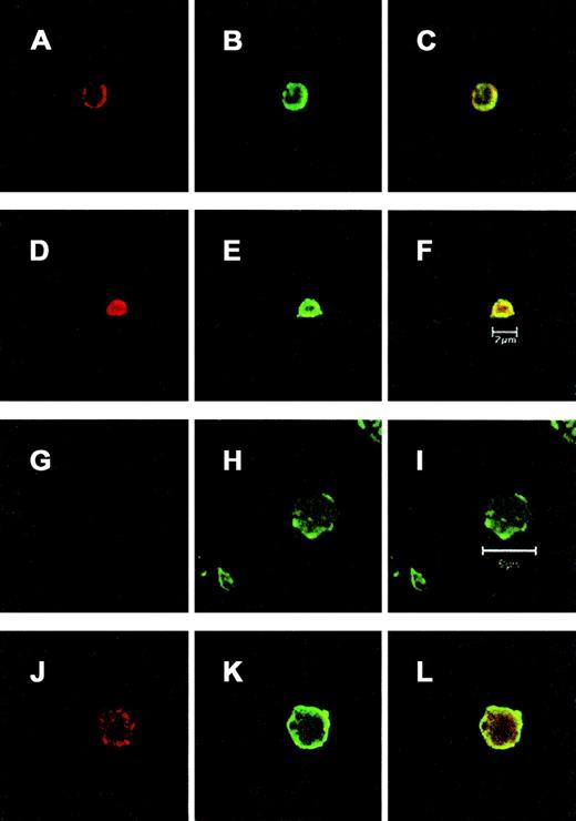 Fig. 3. Fluorescent imaging of platelet GPs. / Washed platelets from healthy volunteers (A-F) and the patient with BSS (G-L) were plated onto glass slides precoated with fibrinogen (20 μg/mL) and allowed to adhere for 1 hour at room temperature. Platelets were then either stained directly (A-C and G-I) or permeabilized with ice-cold methanol and acetone (D-F and J-L) before staining. Slides were dual stained for GPIbα with a rabbit anti-GC polyclonal antibody and for GPIIb-IIIa with a mouse mAb, LYP18. Platelets were imaged on a Zeiss Axioplan II confocal microscope with a 63 × oil immersion lens (1.4 n/a). The platelets were permeabilized in the images shown in A to C and G to I to allow antibody probes to react with cytoplasmic epitopes. Data are presented as triplets of images separated to show GPIbα staining with an Alexa 546–conjugated anti-rabbit antibody (red: A, D, G, and J), GPIIb-IIIa staining with Alexa 488 antimouse antibody (green: B, E, H, and K), or the confocal image showing both colors (C, F, I, and L). One image is shown for each treatment; this is representative of 3 independent experiments in which up to 50 platelets were analyzed. GPIbα was present in permeabilized and nonpermeabilized normal platelets (A, D) and permeabilized BSS platelets (J) but absent from the surface of nonpermeabilized preparations of the BSS platelets (G). In contrast, the platelet integrin GPIIb-IIIa was present on the surface of both normal and BSS platelets, regardless of permeabilizing treatment of the cell membrane (B, E, H, and K).