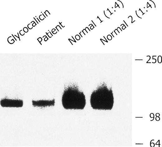 Fig. 5. Western blot analysis of plasma GPIb. / Platelet-poor plasma from 2 healthy volunteers and the patient with BSS was immunoprecipitated with antibody AP1, analyzed by sodium dodecyl sulfate–polyacrylamide gel electrophoresis (SDS-PAGE) on a 4% to 20% gradient gel in the presence of β-mercaptoethanol, and immunoblotted with anti-GPIbα monoclonal antibody MCB142.11. The glycocalicin-positive control (3.8 ng) is shown in lane 1; BSS plasma is shown in lane 2. The control plasma samples were diluted (1:4) before SDS-PAGE to avoid overloading of the gel (lanes 3 and 4). There was less soluble GPIbα in the plasma from the patient with BSS.