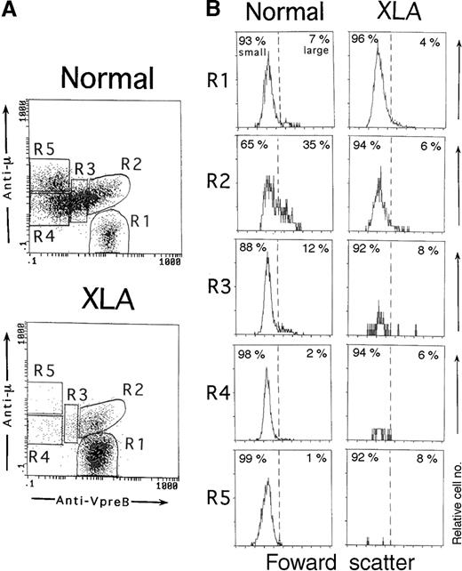 Fig. 3. Three-color immunofluorescence analysis of different stages of B-lineage cells in BM. / BM cells from an 11-month-old healthy infant and an XLA patient (P6) were fixed, permeabilized, and then stained with PE-labeled anti-VpreB and PC5-labeled anti-CD19 mAbs in combination with an FITC-labeled antihuman μH chain Ab. B-lineage cells in BM lymphoid cells were gated by a combination of VpreB and CD19 expression, as described in Figure 1. (A) According to the degree of VpreB and μH chain expression, BM B-lineage cells were arbitrarily divided into 5 fractions: μ−SL++ (R1), μlowSL++ (R2), μlowSL+ (R3), μlowSL− (R4), and μhighSL− (R5) cells. R1, R2, R3, R4, and R5 fractions comprise 7.6%, 9.9%, 19.0%, 38.8%, and 24.6%, respectively, of the normal BM or 76.8%, 14.8%, 3.9%, 3.1%, and 1.0% of the XLA BM. (B) The cell size of each fraction of BM-lineage cells was assessed by forward scatter. In normal BM, large cells were more enriched in the R2 fraction. By contrast, all fractions were mainly composed of small cells in XLA BM.
