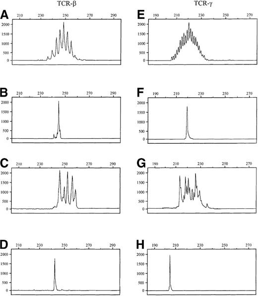 Fig. 2. Comparison of the fluorescence-labeled TCR-β and TCR-γ PCR products by GeneScan analysis. / The x-axes represent molecular size (base pairs) and the y-axes fluorescence intensity. Samples A-D were produced by TCR-β PCR and samples E-H by TCR-γ PCR. (A, E) Normal tonsillar tissue. (B, F) Cutaneous T-cell lymphoma (case 23). (C, G) Psoriasis. (D) T-cell line HUT102 (243 bp). (H) T-cell line HUT102 (205 bp). Note: TCR-β PCR products regularly differ by 3 base pairs, indicating the presence of functional TCR-β rearrangements. TCR-γ PCR products differ by only 1 base pair, indicating frequent out-of-frame rearrangements.