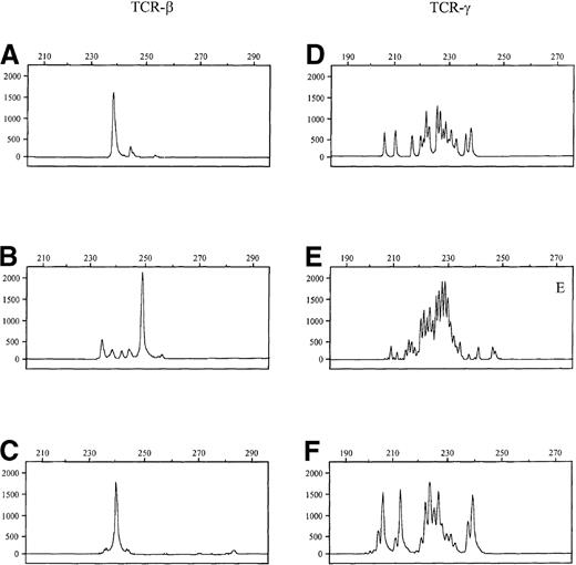 Fig. 3. Comparison of results. / Comparison of TCR-β (A-C) and TCR-γ (D-F) PCR results obtained in 3 T-cell lymphomas with clonal TCR-β rearrangements and poly/oligoclonal TCR-γ rearrangements by GeneScan analysis. (A, D) Anaplastic large cell lymphoma (case 53). (B, E) Peripheral T-cell lymphoma, unspecified (case 34). (C, F) Intestinal T-cell lymphoma (case 50).