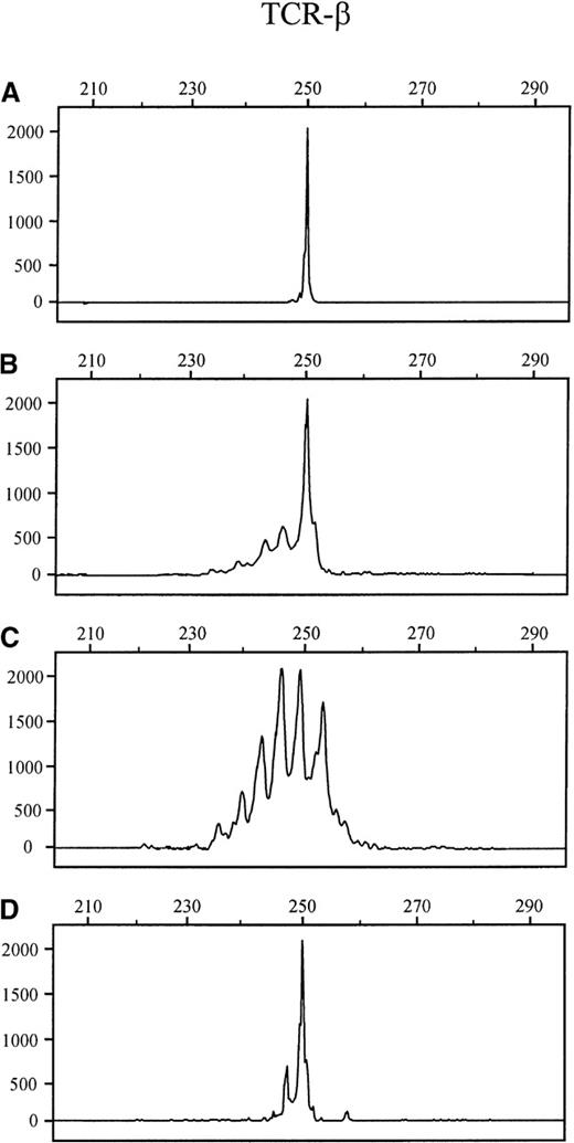 Fig. 4. Follow-up by GeneScan analysis in a patient with cutaneous T-cell lymphoma (case 12) by TCR-β PCR. / (A) Plaque-stage at the time of first diagnosis. (B) Lymph node involvement half year later. (C) Peripheral blood at the time of lymph node involvement. (D) Skin lesion 2 years after chemotherapy; relapse. Note: The same clonal TCR-β rearrangement (250 bp) is detectable in all tissue specimens, but not in the peripheral blood sample.