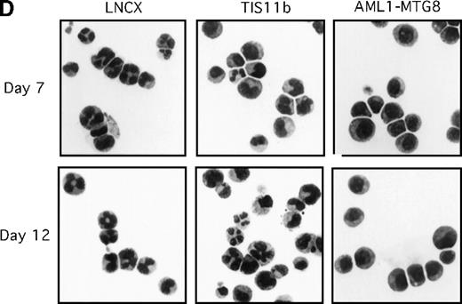 Fig. 4. Overexpression of TIS11b. / Overexpression of TIS11b induced G-CSF–dependent proliferation of L-G cells but did not block their terminal differentiation as completely as AML1-MTG8. (A) G-CSF–dependent growth of control (LNSX and LNCX) and AML1-MTG8- and TIS11b-expressing L-G cells. Three infections were independently performed for each construct. These infected cells were separately cultured in the presence of 10 ng/mL G-CSF instead of IL-3. The averages of these 3 experiments are shown. Error bars indicate standard deviations. (B) Comparison of the expression of TIS11bby Northern blotting analysis in control (LNSX and LNCX) and AML1-MTG8- and TIS11b-expressing L-G cells. The membrane was successively hybridized with mouse TIS11b cDNA and human G3PDH cDNA. The positions of bands representing the endogenous TIS11b and the exogenousTIS11b genes, whose expression was directed by the LTR (upper) and the CMV promoter (lower) of the LNCX vector, are indicated on the right. The signal of the lower exogenous TIS11b gene transcript was about 10-fold higher than that of the endogenous TIS11bgene transcript in control cells. (C) Western blotting analysis of the expression of AML1-MTG8 and TIS11b in the infected L-G cells. Each protein was detected with anti-HA antibody. The positions of bands of AML1-MTG8 and TIS11b are indicated on the right. (D) Nuclear morphology of the L-G infectants when cultured in the presence of G-CSF. The cells cultured in the presence of G-CSF were stained with May-Grünwald and Giemsa solutions at the indicated days.