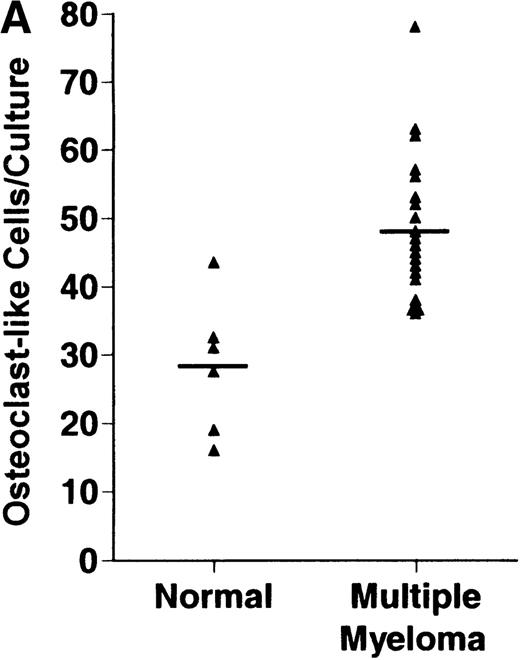 Fig. 1. Stimulation of OCL formation. / (A) Effects of bone marrow plasma from controls and patients with MM on OCL formation in human marrow cultures. Bone marrow plasma and marrow cultures were processed as described in “Materials and methods.” Results represent the mean ± SEM for all assays done in quadruplicate. Bone marrow plasma from patients with MM significantly stimulated the formation of OCLs in human bone marrow cultures when compared to controls (47.75 ± 6 versus 28.25 ± 5 multinucleated cells/105 cells plated, respectively,P < .05). (B) Correlation of OCL formation induced by marrow plasma from 12 patients with MM and their respective levels of β2 microglobulin. Bone marrow plasma and marrow cultures were processed as described in “Materials and methods.” The relative levels of OSF positively correlated with β2microglobulin levels in patients with MM with normal renal function (correlation coefficient = 0.708).